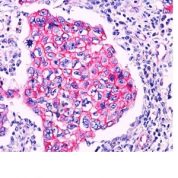 FFPE breast carcinoma, ductal sections stained with 100 ul anti-beta-Catenin (clone Polyclonal) at 1:200. HIER epitope retrieval prior to staining was performed in 10mM Tris 1mM EDTA, pH 9.0.